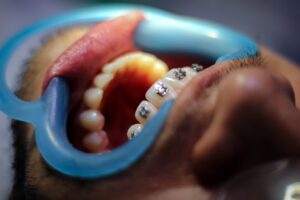 Exploring Options for Straighter Teeth